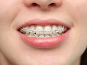 #1 Braces treatment in Ahmedabad | Painl