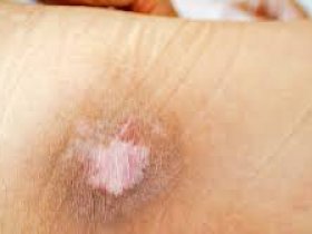 Bed Sores Treatment at Home