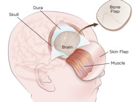 Brain Tumor Surgery Cost in India