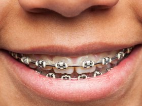 Cheap Braces Selangor