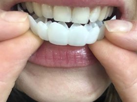 Clip on Veneers