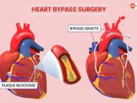 Coronary Bypass treatment in india