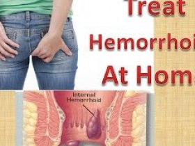 Hemorrhoids Cure
