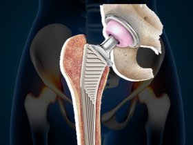 Hip Replacement Surgery Cost in India