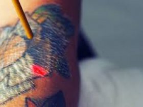 Importance of Laser Tattoo Removal