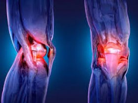 Knee Replacement Surgery Cost in India