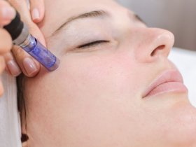 Laser Treatments Vs. Microneedling