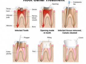 Root Canal Dentist Park Slope