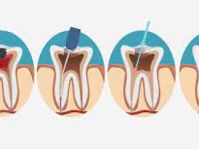 Root canal treatments in Bahrain