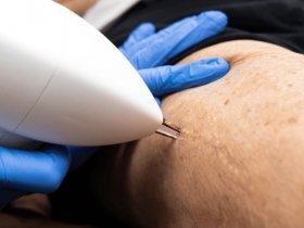 Sclerotherapy