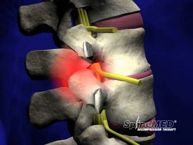Spinal decompression therapy Novi