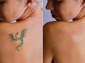 Tattoo Over Laser Tattoo Removal
