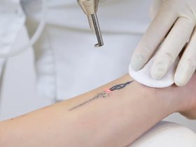 Tattoo Removal