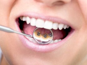 Teeth Braces | Orthodontist