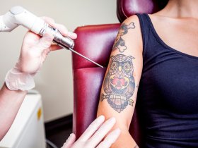 Will Laser Hair Removal Ruin Your Tattoo