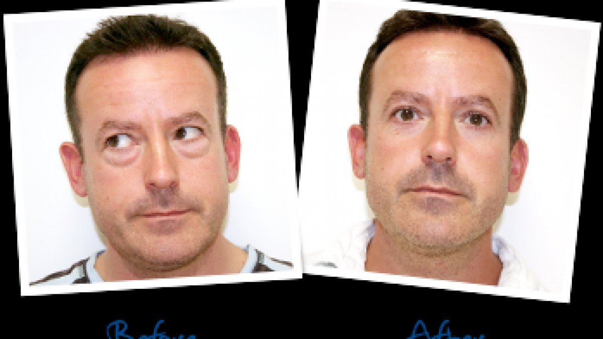 Eye Bag Removal Surgery